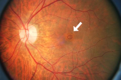 macular holes